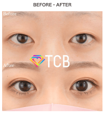 TCB東京中央美容外科の埋没二重整形症例クチコミ症例B