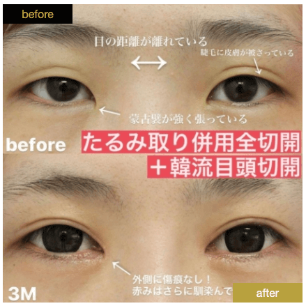 グローバルビューティークリニック瞼のたるみ症例