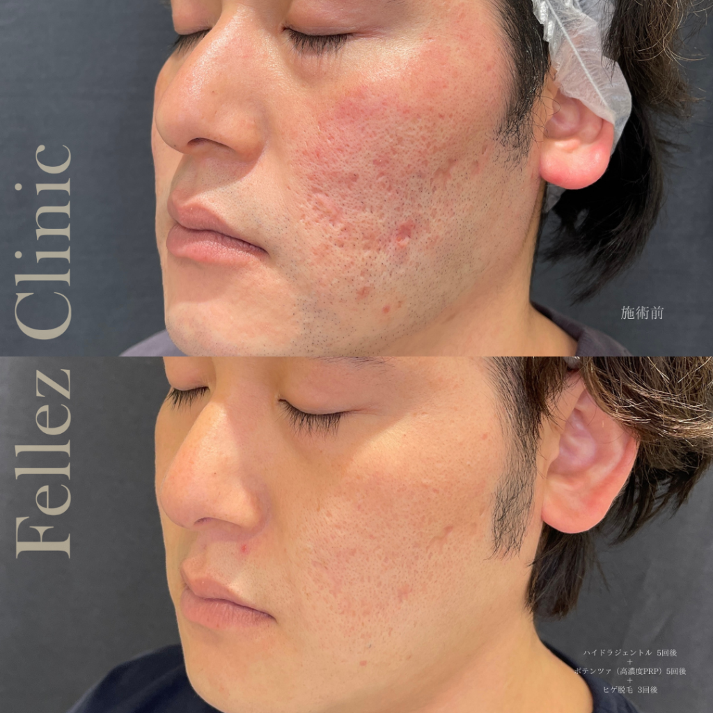 ポテンツァで高濃度PRPを使用したニキビ跡のクレーター治療