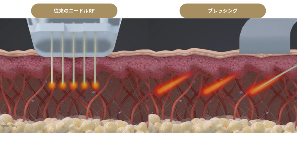 ブレッシング_BLESSING_RF_高周波