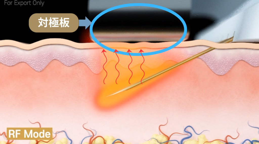 ブレッシング_BLESSING_傾斜ニードルRF_対極板
