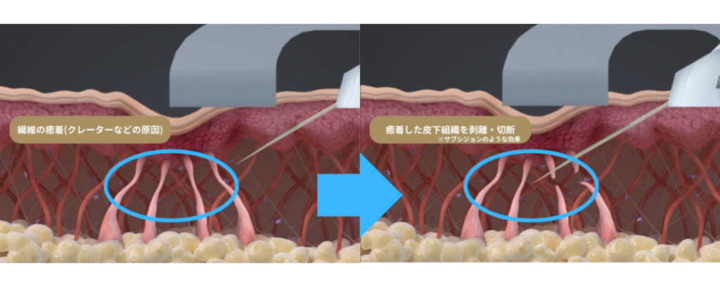 ブレッシング_BLESSING_傾斜ニードルRF_サブシジョン