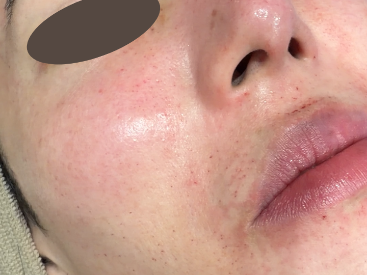 ブレッシング_BLESSING_症例_右頬_施術中写真