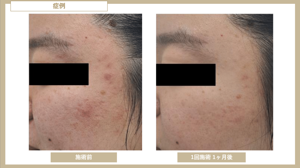 ブレッシング_BLESSING_症例_左頬_1回_1month