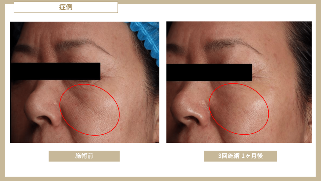 ブレッシング_BLESSING_症例_左頬_3回_1month