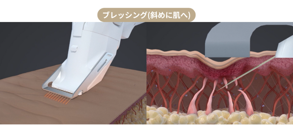ブレッシング_BLESSING_傾斜ニードルRF_イメージ