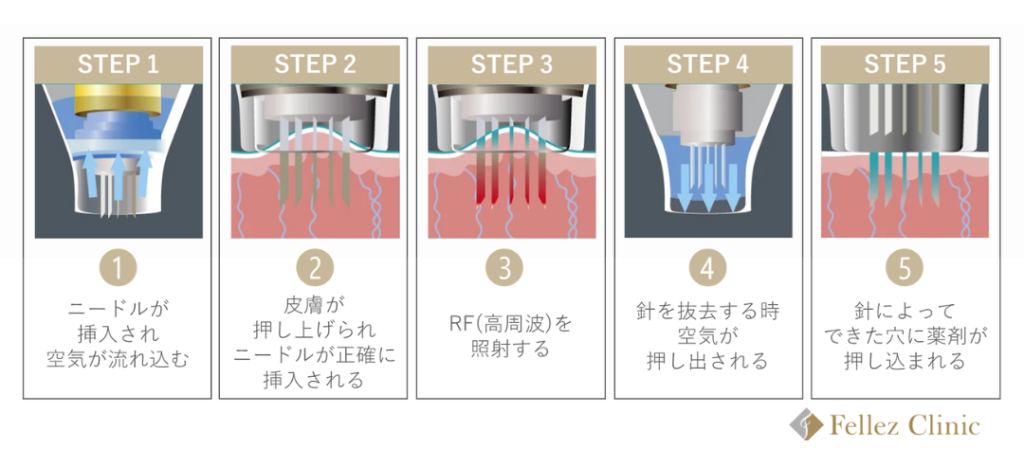 ポテンツァ_ドラッグデリバリーシステム_薬剤導入