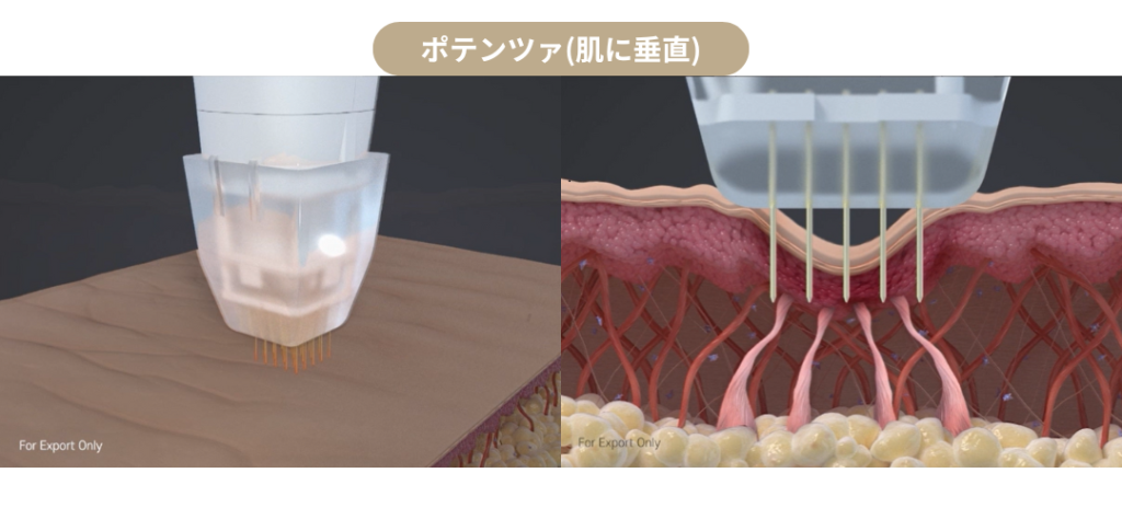 ポテンツァ_針_垂直
