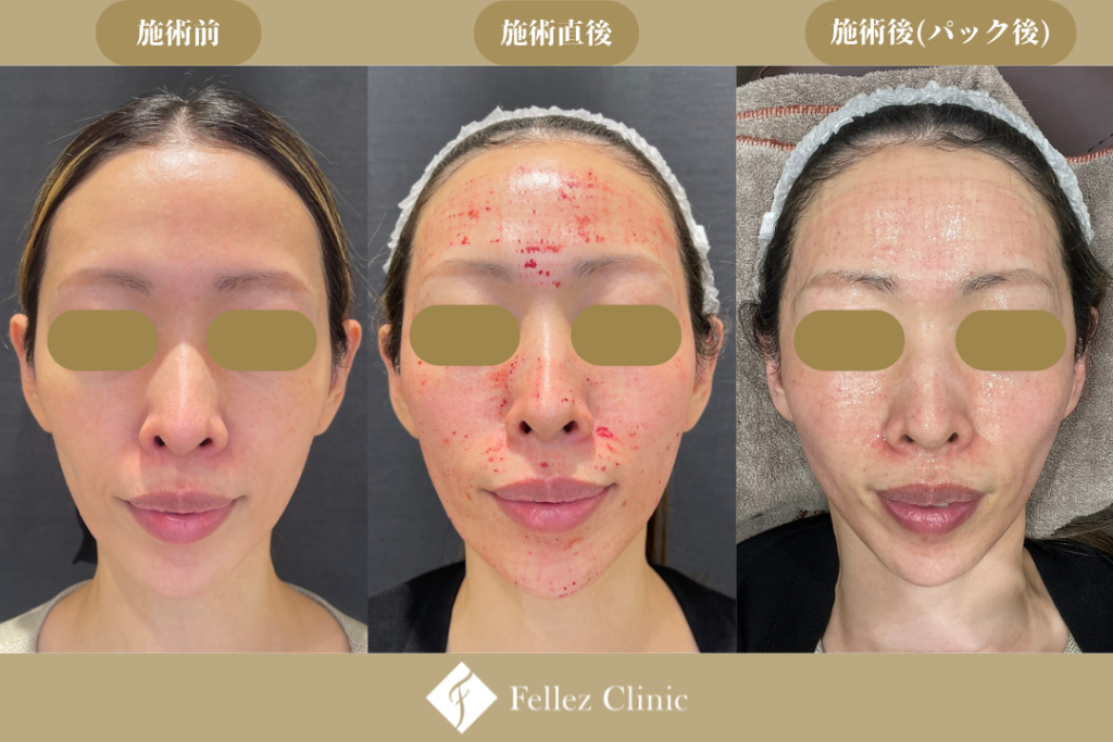 ブレッシングの経過症例写真-施術前&施術後-　ダウンタイム