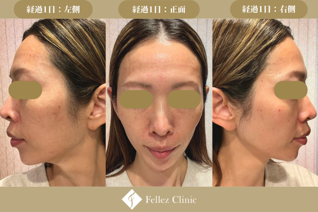 ブレッシングの経過症例写真-術後1日-　ダウンタイム