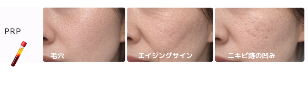 ブレッシングの薬剤の内、高濃度PRPが合う肌