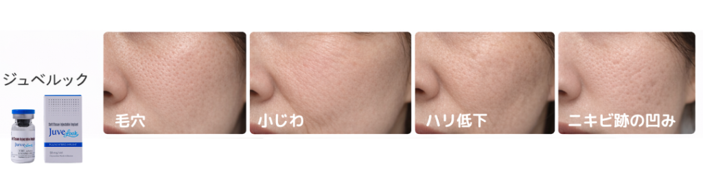 ブレッシングの薬剤の内、ジュベルックが合う肌