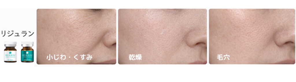 ブレッシングの薬剤の内、リジュランが合う肌