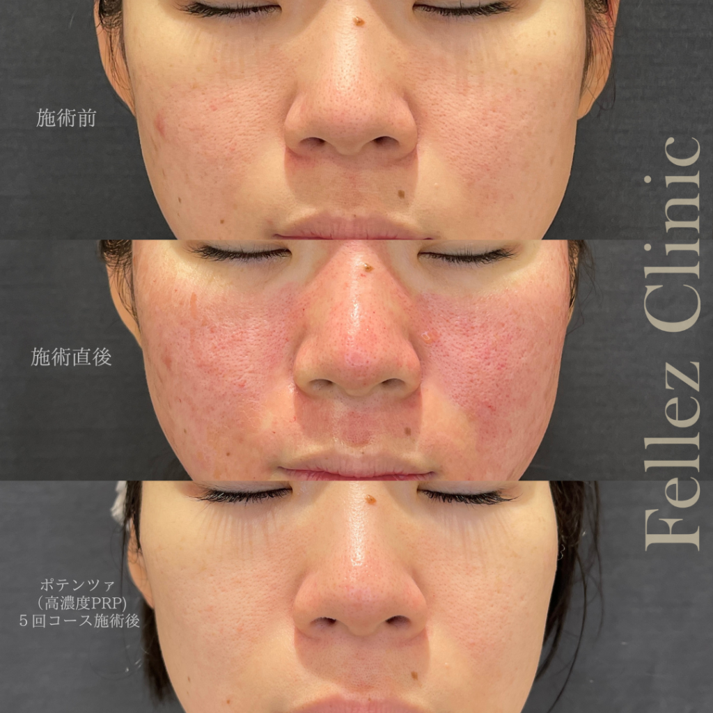 ポテンツァで高濃度PRPを使用したニキビ跡のクレーター治療